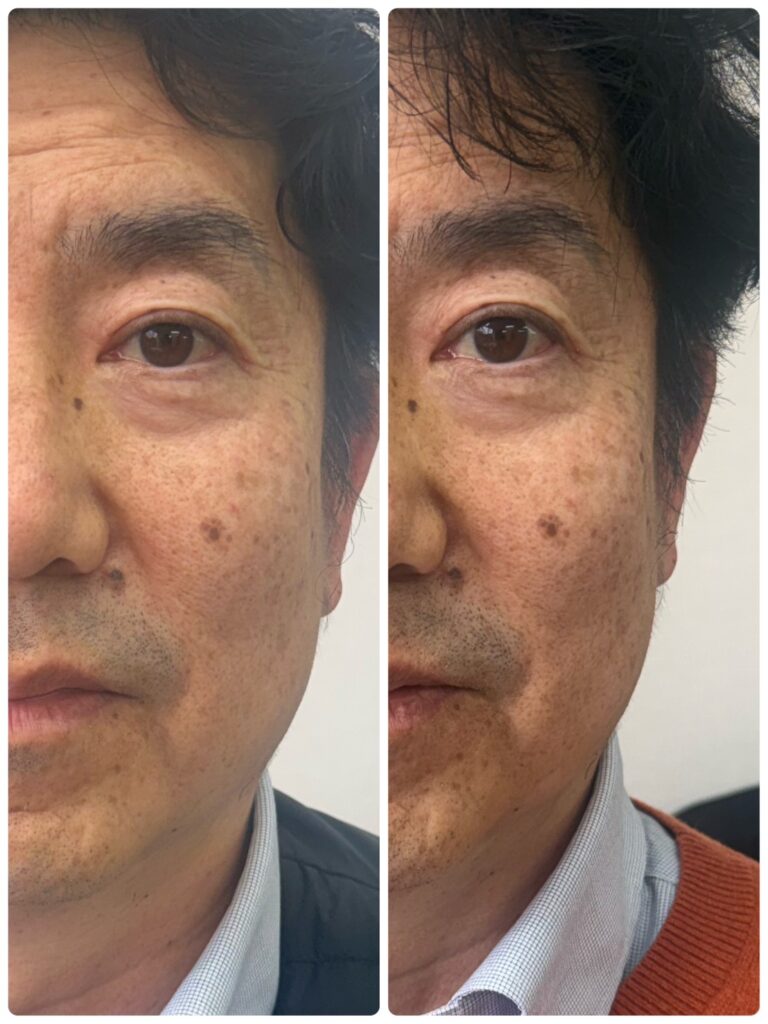 Dr. Spa Personalで、ヘッドスパ体験（60代男性）。左半分を5分間ケアしたところ。