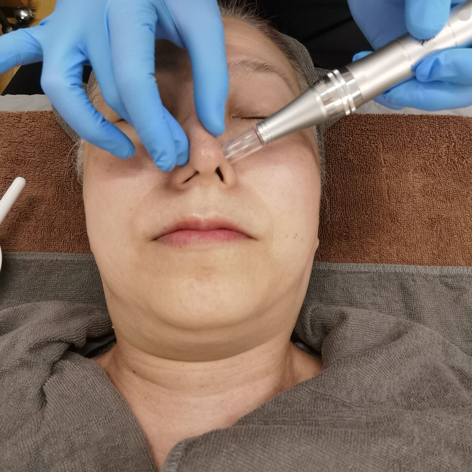 ソフトダーマで鼻まわりに施術中